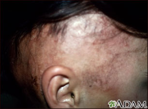 Alopecia bajo tratamiento Alopecia bajo tratamiento