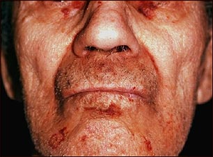 Amiloidosis de la cara Amiloidosis de la cara