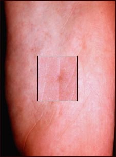 Síndrome de nevo de célula basal en depresión plantar Síndrome de nevo de célula basal en depresión plantar