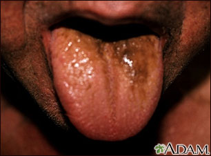 Lengua negra peluda Lengua negra peluda