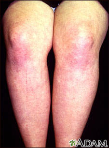 Dermatomiositis en las piernas Dermatomiositis en las piernas