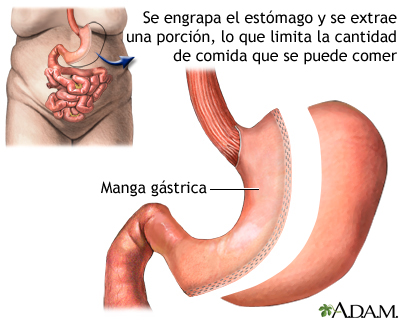Procedimiento de manga gástrica Procedimiento de manga gástrica