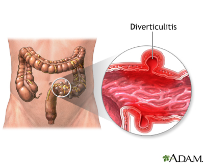 Diverticulitis Diverticulitis