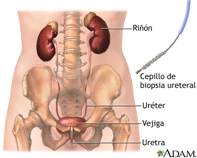 Biopsia ureteral Biopsia ureteral