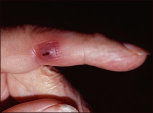 Lesión de Janeway en un dedo Lesión de Janeway en un dedo