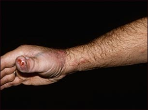 Esporotricosis en la mano y el brazo Esporotricosis en la mano y el brazo