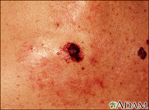 Cáncer de piel - primer plano del melanoma de nivel IV Cáncer de piel - primer plano del melanoma de nivel IV