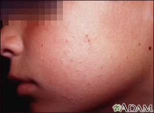 Queratosis pilaris de la mejilla Queratosis pilaris de la mejilla