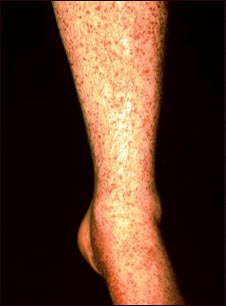 Vasculitis Vasculitis