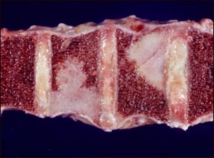 Tumor de la espina dorsal Tumor de la espina dorsal