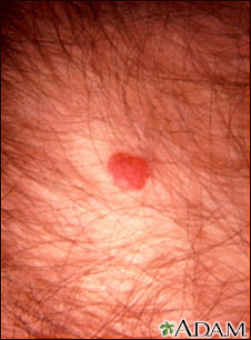 Sarcoma de Kaposi - perianal Sarcoma de Kaposi - perianal