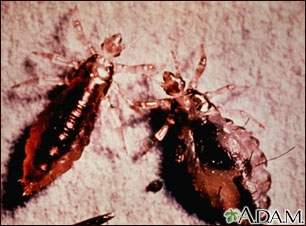 Cuerpo y heces del piojo de cuerpo (Pediculus humanus) Cuerpo y heces del piojo de cuerpo (Pediculus humanus)