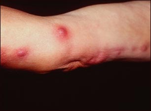 Esporotricosis en el brazo Esporotricosis en el brazo