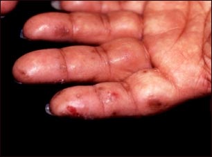 Dermatitis herpetiforme en la mano