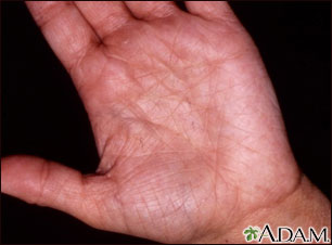 Hiperlinearidad de la dermatitis atópica Hiperlinearidad de la dermatitis atópica