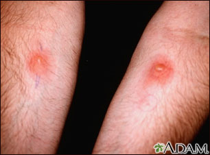 Examen de piel - PPD (brazo derecho) y Candida (izquierdo) Examen de piel - PPD (brazo derecho) y Candida (izquierdo)