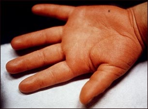 Enfermedad de Kawasaki - edema de la mano Enfermedad de Kawasaki - edema de la mano