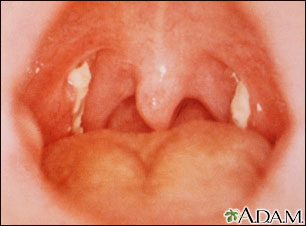 Mononucleosis - vista de la garganta Mononucleosis - vista de la garganta
