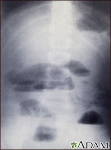 Radiografía de obstrucción del intestino delgado Radiografía de obstrucción del intestino delgado
