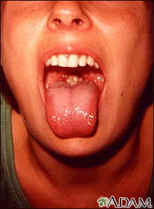 Mononucleosis - boca Mononucleosis - boca