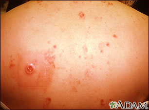 Cáncer múltiple de célula basal por terapia con rayos X para el acné Cáncer múltiple de célula basal por terapia con rayos X para el acné