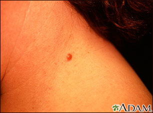 Queratosis seborreica irritada en el cuello Queratosis seborreica irritada en el cuello