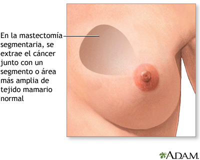 Mastectomía - Procedimiento (primera parte)