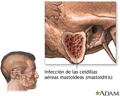 Mastoiditis - Indicaciones Mastoiditis - Indicaciones