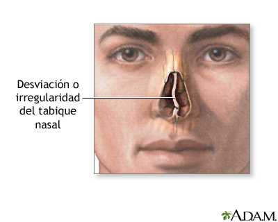 Indicaciones - Desviación septal Indicaciones - Desviación septal