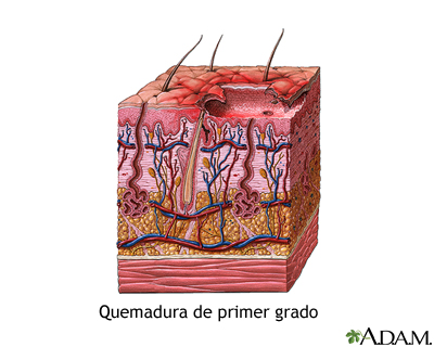 Quemadura de primer grado Quemadura de primer grado