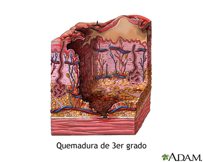 Quemadura de tercer grado Quemadura de tercer grado