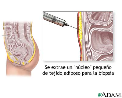 Biopsia de tejido graso Biopsia de tejido graso