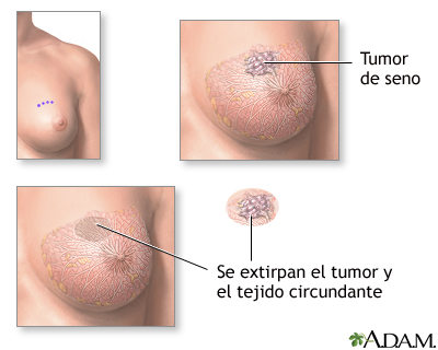 Excisión de un tumor en el seno Excisión de un tumor en el seno