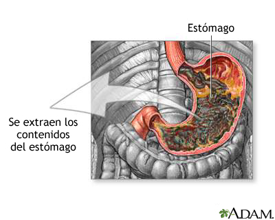Succión gástrica Succión gástrica