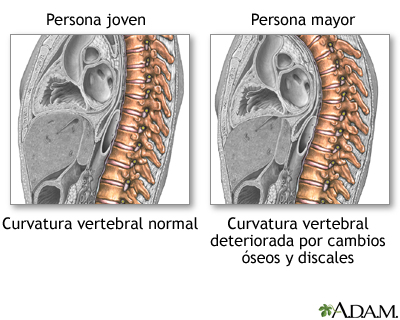 Cambios en la columna por envejecimiento Cambios en la columna por envejecimiento