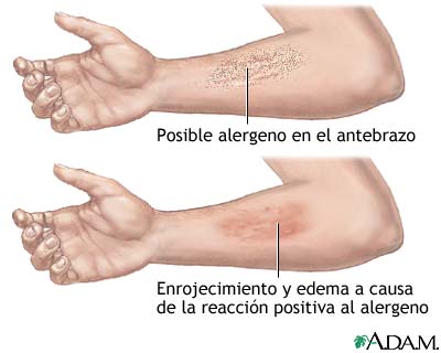 Reacción positiva a un alergeno Reacción positiva a un alergeno