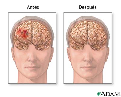 Antes y después de la reparación de un hematoma Antes y después de la reparación de un hematoma