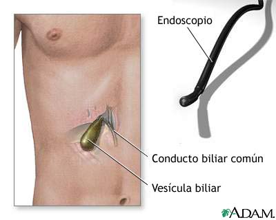 Endoscopia de vesícula biliar Endoscopia de vesícula biliar