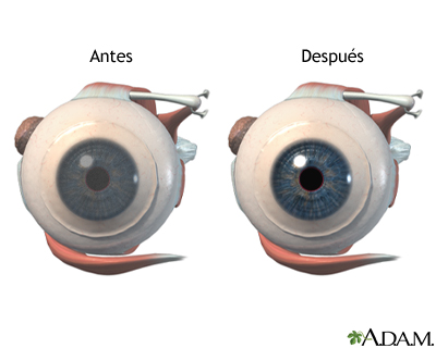 Antes y después de cirugía corneal Antes y después de cirugía corneal