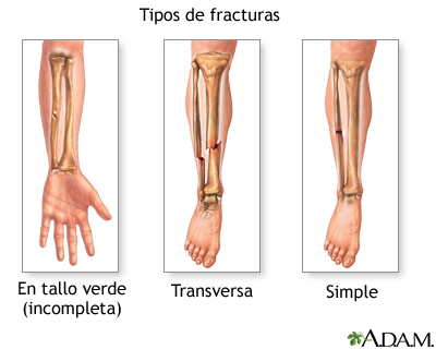 Tipos de fractura (2) Tipos de fractura (2)
