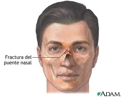 Fractura nasal Fractura nasal