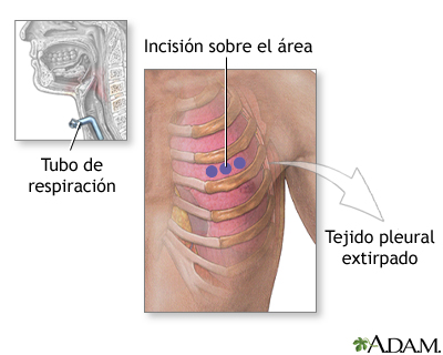 Incisión para biopsia de tejido pleural Incisión para biopsia de tejido pleural