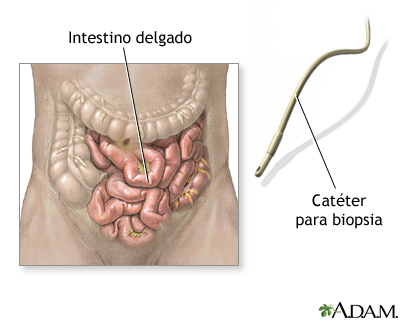 Biopsia del intestino delgado Biopsia del intestino delgado