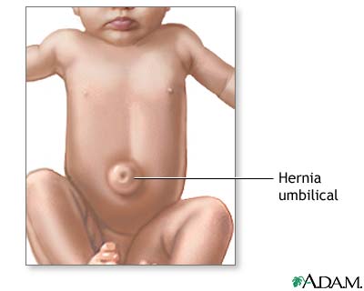 Hernia umbilical Hernia umbilical