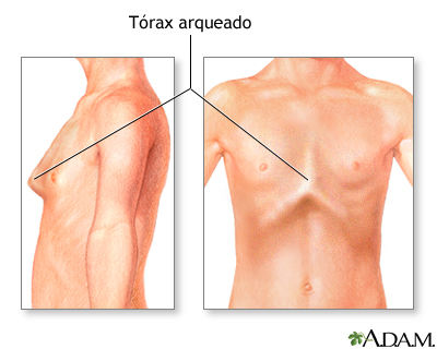 Tórax arqueado (pecho de paloma) Tórax arqueado (pecho de paloma)