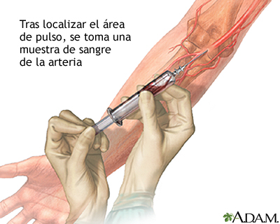 Muestra de sangre arterial Muestra de sangre arterial