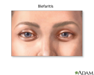 Blefaritis Blefaritis