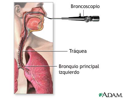 Broncoscopio Broncoscopio