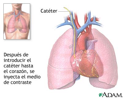 Cateterización cardíaca Cateterización cardíaca