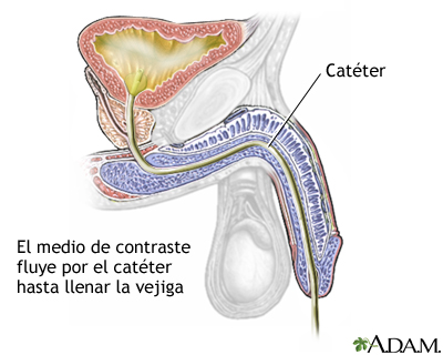 Cistografía Cistografía